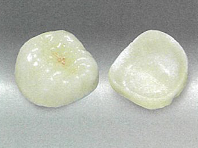 ホワイト e. セラミック・奥歯の被せ物